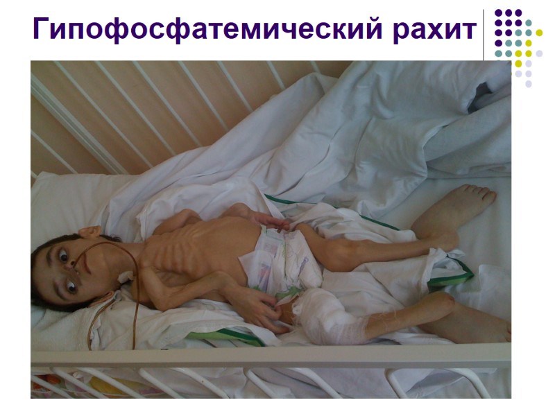 Гипофосфатемический рахит